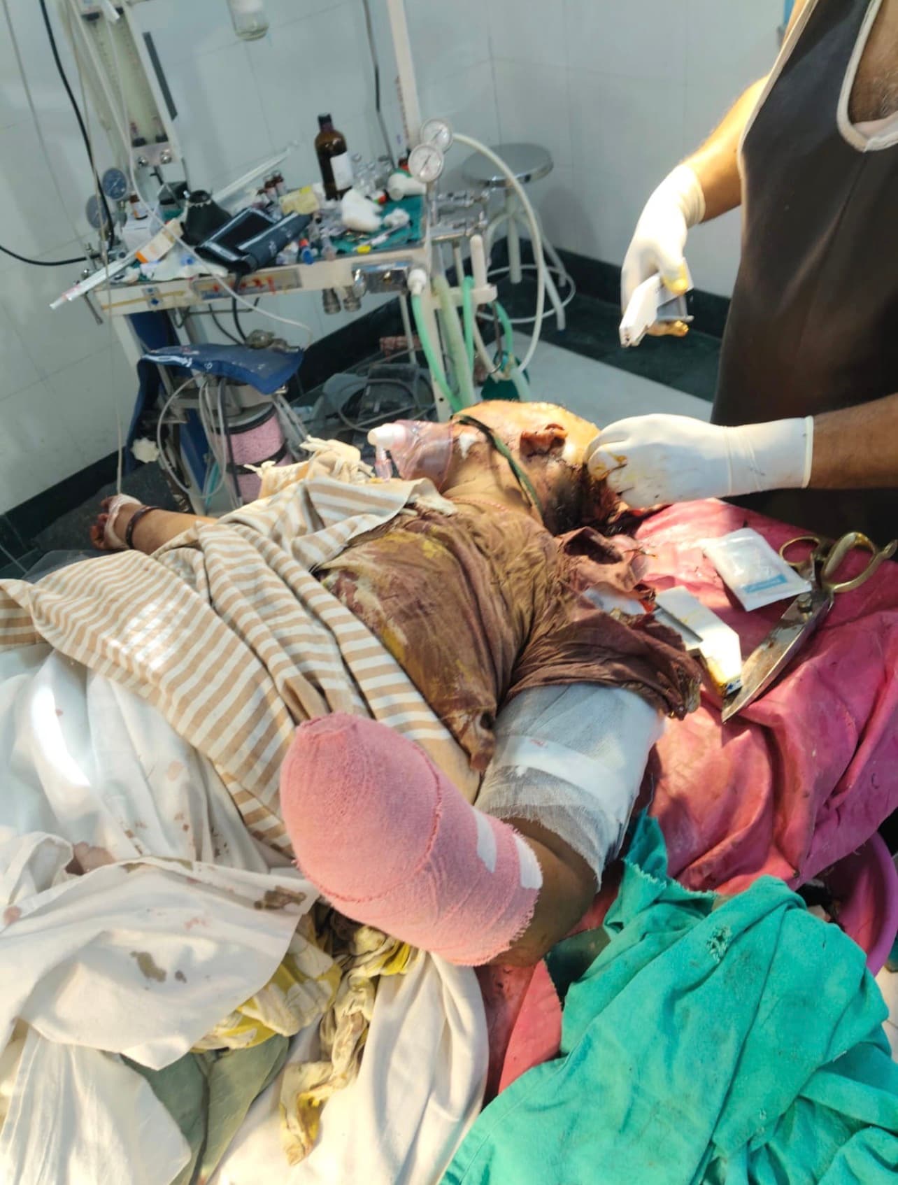 Photo of Juhi, a survivor of a violent dowry attack, currently undergoing recovery and medical treatment after suffering severe physical injuries.